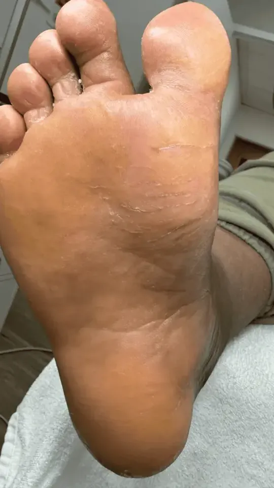 After: callused, dry skin on the sole after a medical pedicure in Rockville, MD