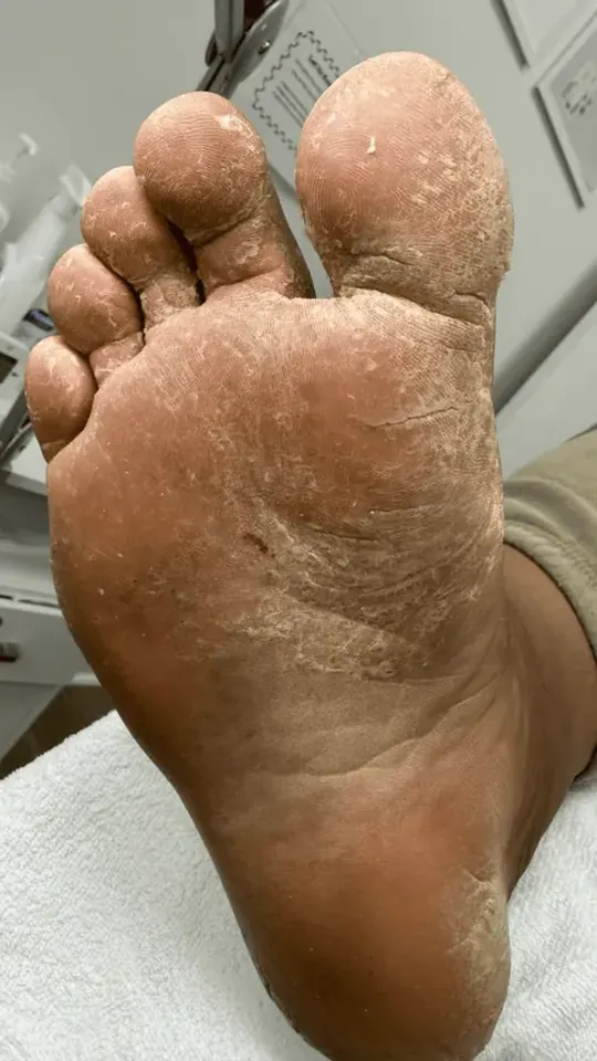 Before: callused, dry skin on the sole