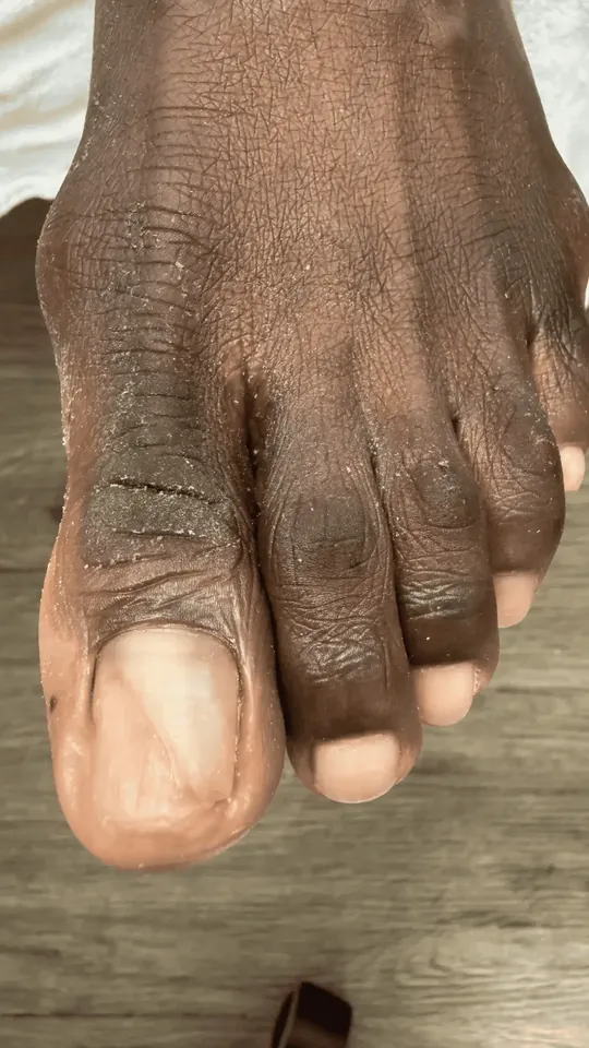 After: damaged big toenail after a medical pedicure in Rockville, MD