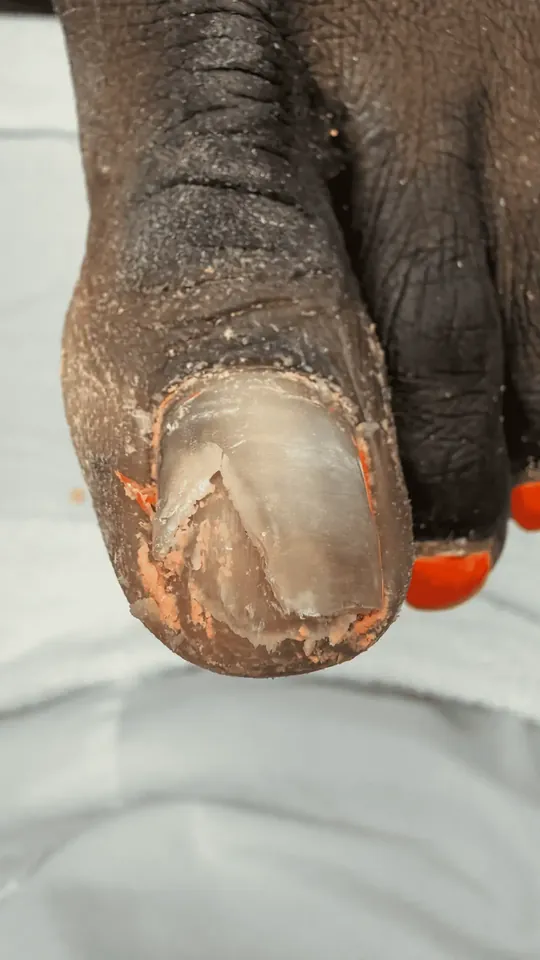 Before: damaged big toenail