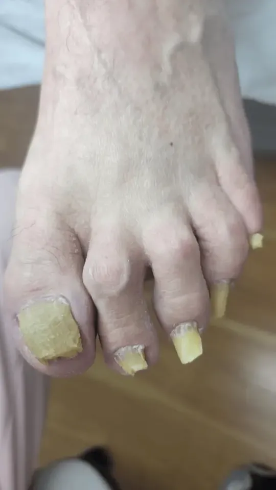 Before: long, thickened yellow toenails