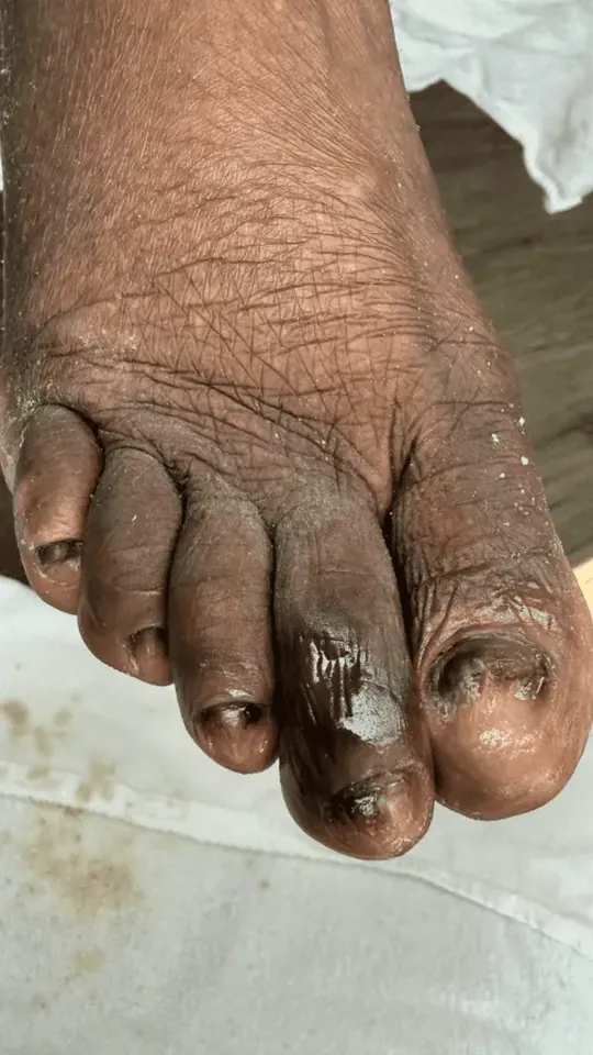 After: severely thickened, curved toenails after a medical pedicure in Rockville, MD