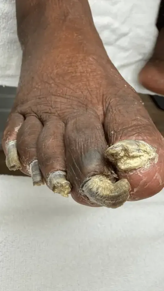 Before: severely thickened, curved toenails