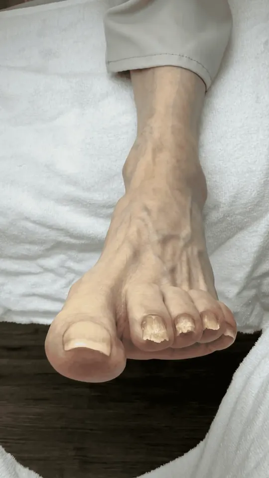 Before: yellow, crumbling toenails