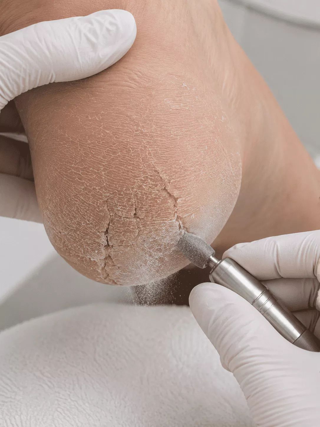 Podology specialist performing hardware exfoliation on cracked heels in Rockville MD