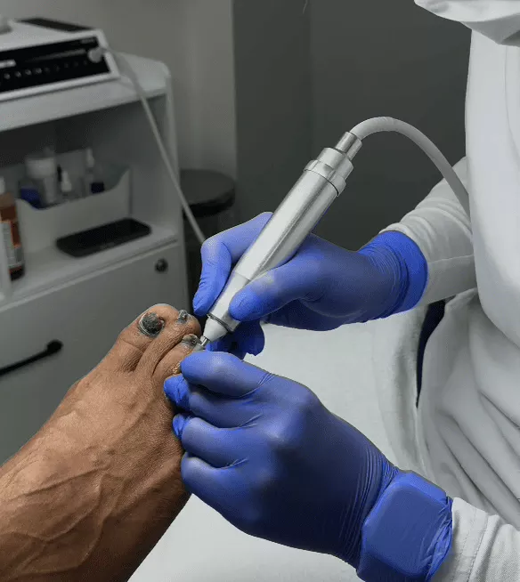 Specialist performing advanced restorative foot care on complex calluses