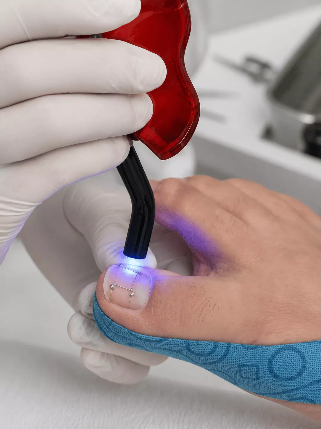 Podology specialist applying a custom Titanium Thread toenail brace
