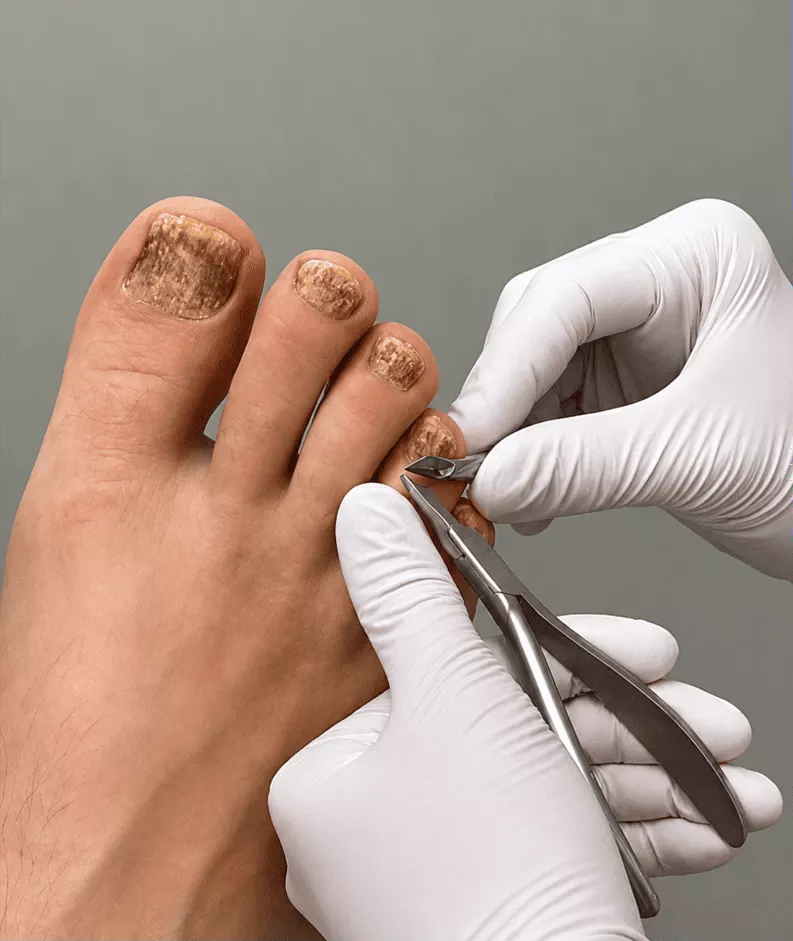 Specialist using advanced spray device for fungal nail restoration in Rockville MD
